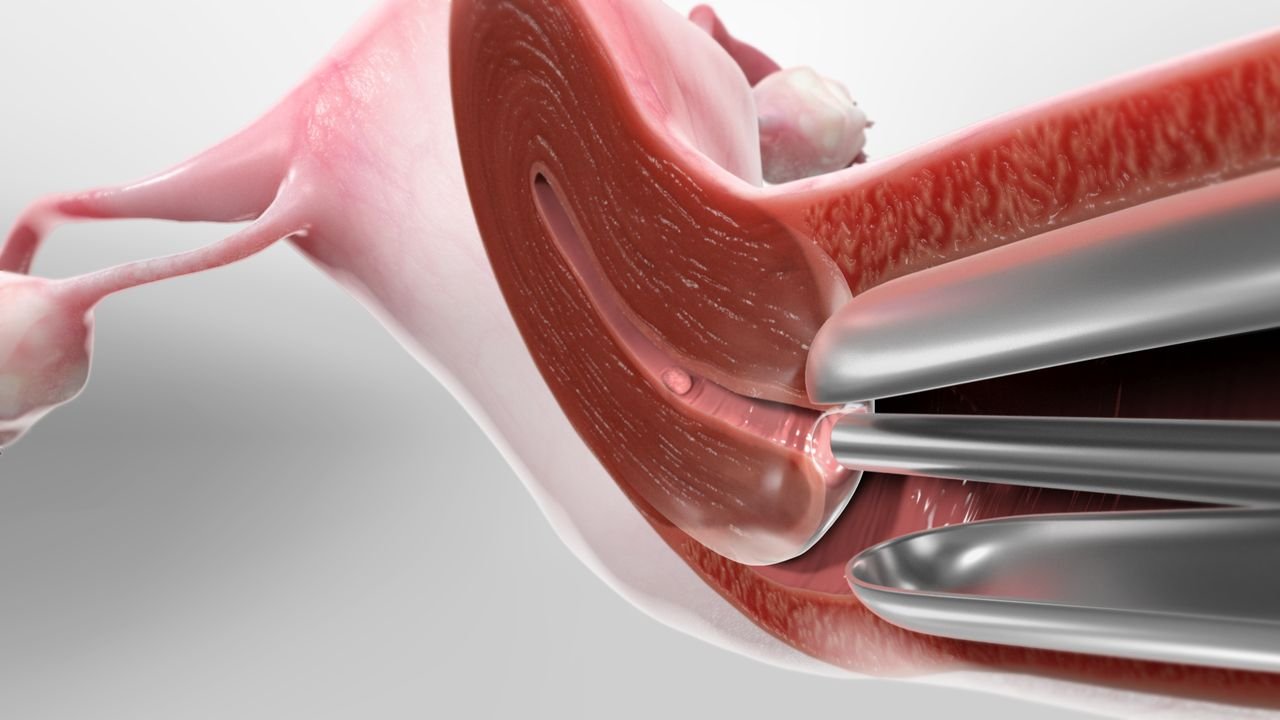Hysteroscopy and Uterine Care