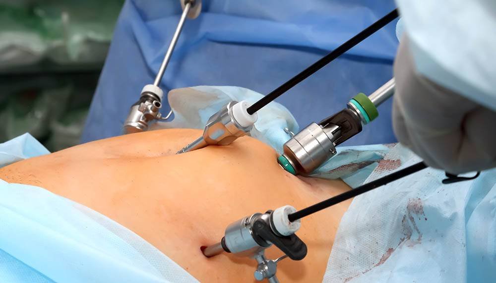 Laparoscopic and Minimally Invasive Surgery