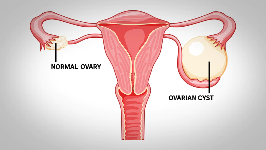 Ovarian Cyst Management